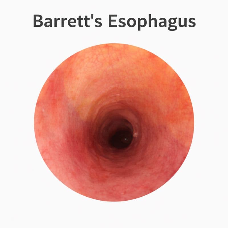 Barrett's Oesophagus