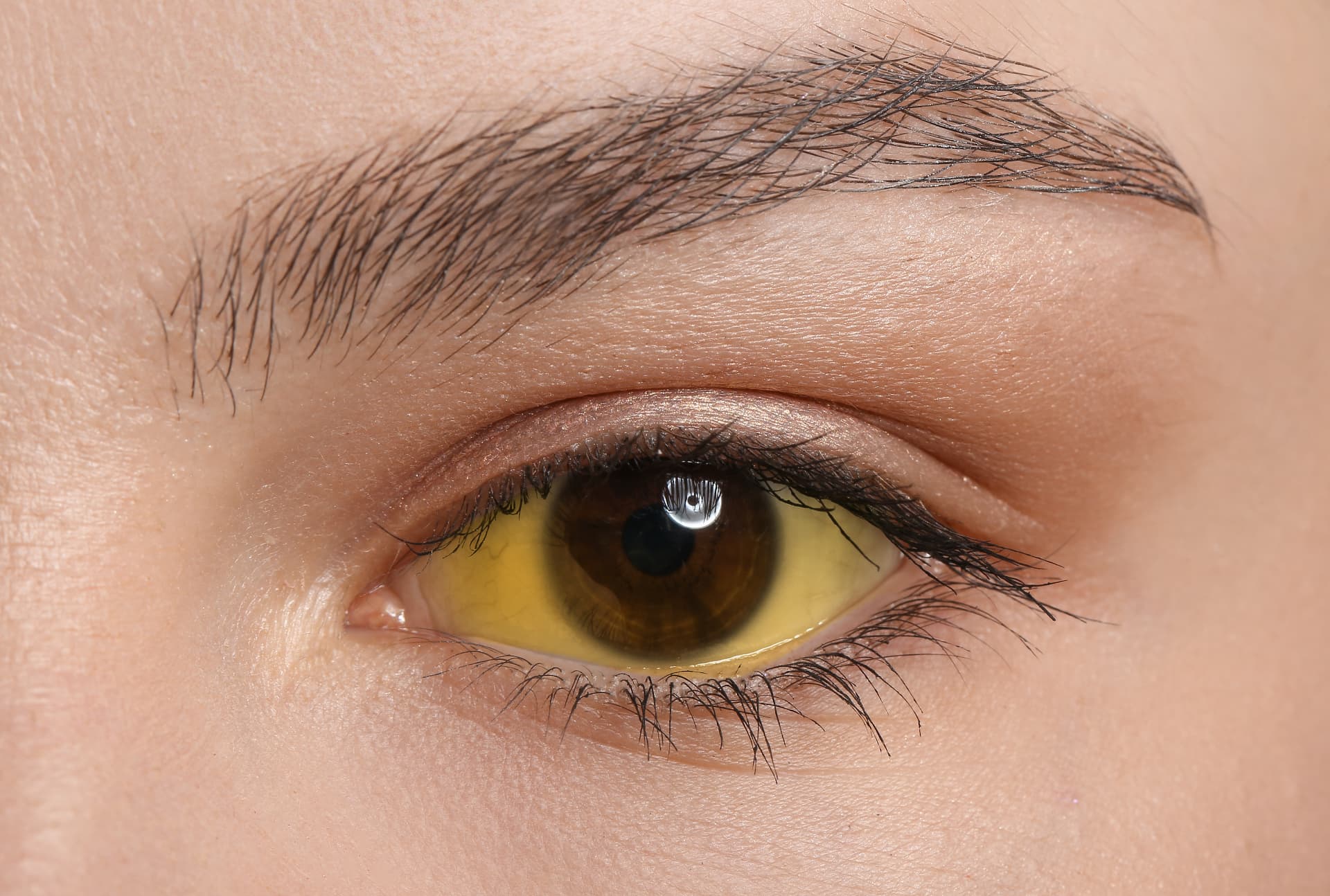 Yellowing of the eye (scleral icterus), a common sign of jaundice
