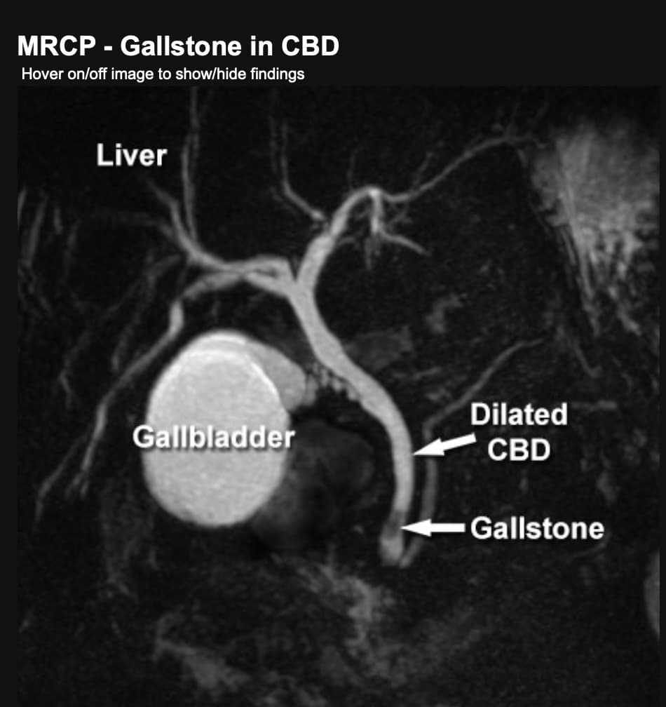 MRCP (Magnetic Resonance Cholangiopancreatography)